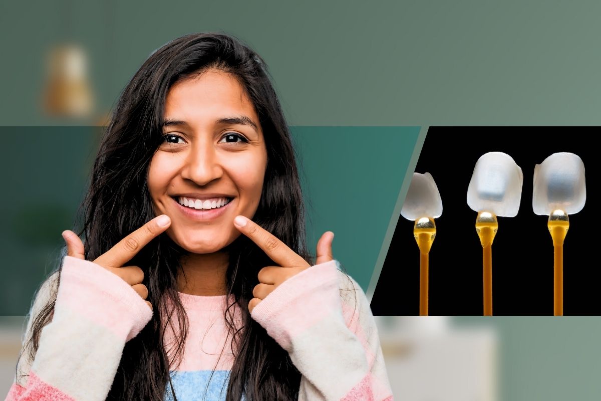 Veneers and laminates